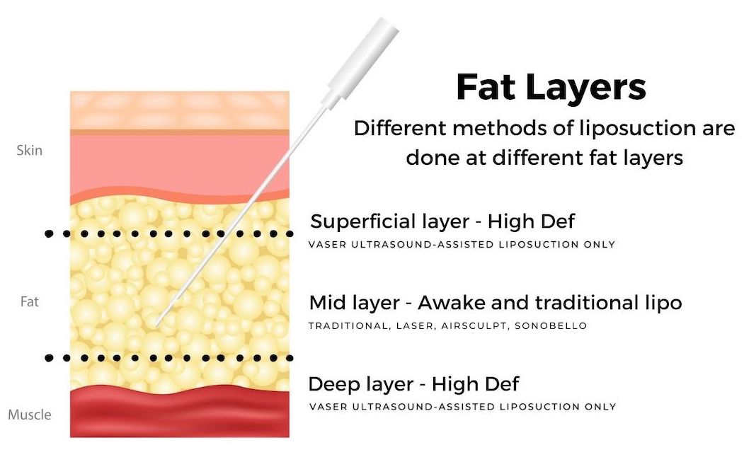 Awake liposuction fat layers