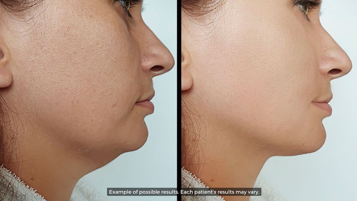 Double Chin Removal